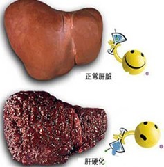 肝硬化有什么癥狀