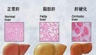 什么是脂肪肝