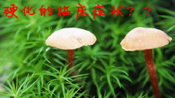 肝硬化的臨床癥狀有哪些