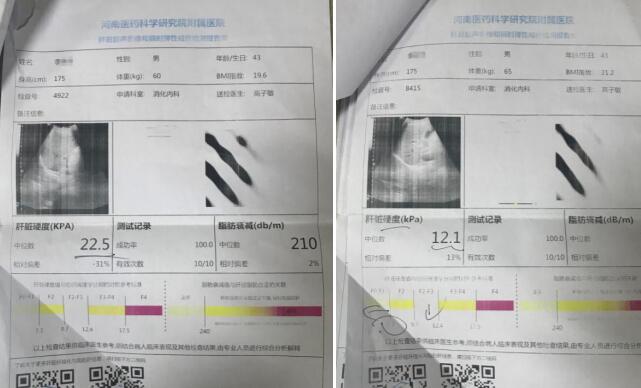 鄭州肝病患者臨床應(yīng)用專利軟肝術(shù) 成功逆轉(zhuǎn)肝硬化